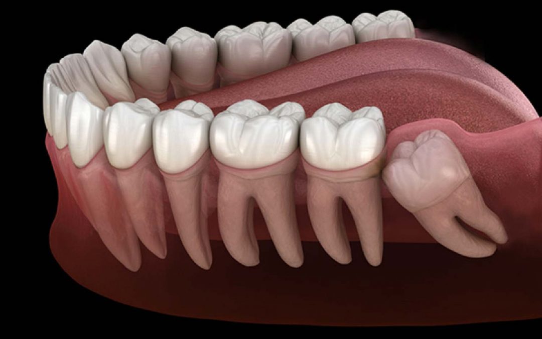 Hai messo i denti del giudizio?